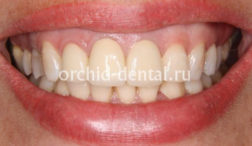 Image after