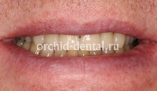 Image after
